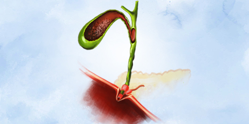 5 мифов про холецистит